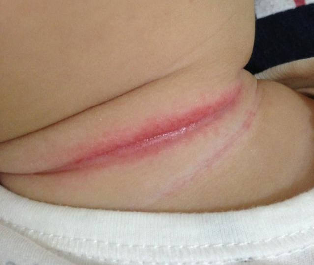 寶淹脖子發紅怎么護理 如何避免淹脖子復發 寶淹脖子發紅怎么護理 如何避免淹脖子復發