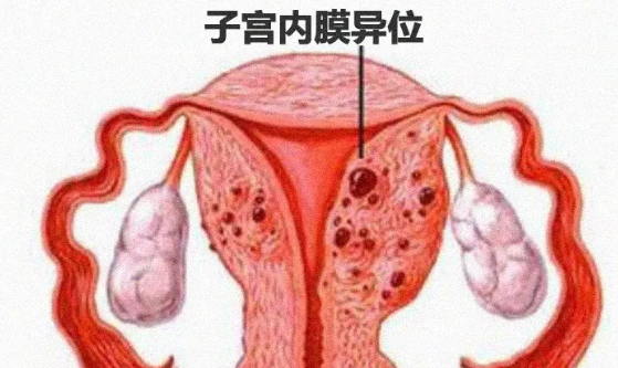 子宮內膜異位癥還能懷孕嗎 女性子宮內膜異位癥嚴重嗎