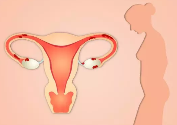 子宮內膜異位癥和遺傳有關嗎 子宮內膜異位癥能做試管嬰兒嗎 子宮內膜異位癥和遺傳有關嗎 子宮內膜異位癥能做試管嬰兒嗎