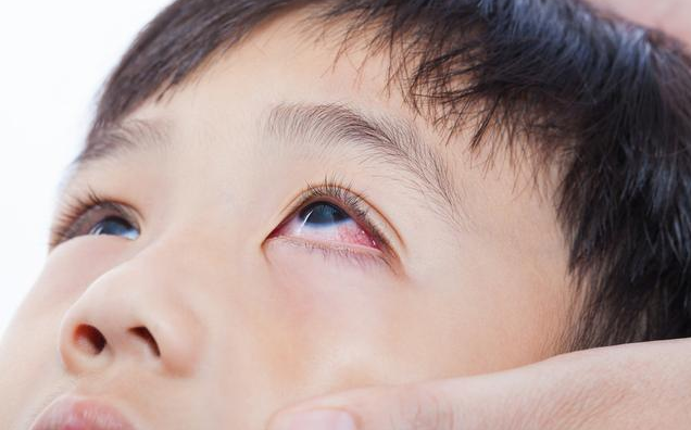 兒童感染腺病毒有哪些癥狀 兒童感謝腺病毒怎么治療 兒童感染腺病毒有哪些癥狀 兒童感謝腺病毒怎么治療