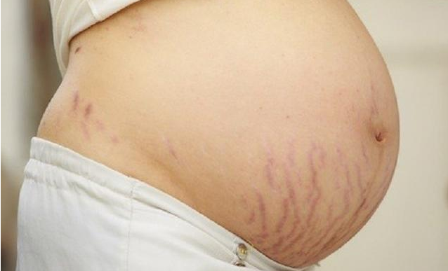 孕婦怎么防止長妊娠紋 妊娠紋醫學治療方法