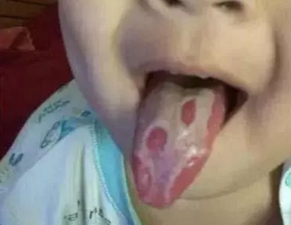 孩子出現口腔潰瘍的原因是什么 孩子口腔潰瘍怎么應對 孩子出現口腔潰瘍的原因是什么 孩子口腔潰瘍怎么應對