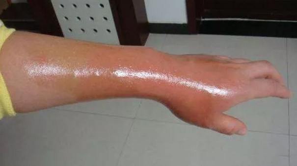 孩子被燙后第一時間怎么做好 孩子被燙了正確處理順序