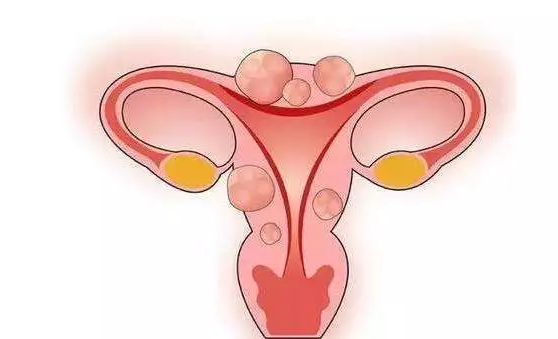 子宮內膜太厚怎么治療 子宮內膜太厚和生活習慣有關嗎 子宮內膜太厚怎么治療 子宮內膜太厚和生活習慣有關嗎