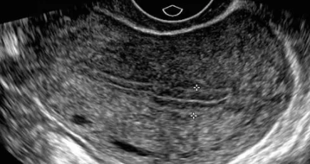 子宮內(nèi)膜太厚需要刮宮嗎 子宮內(nèi)膜多厚才需要刮宮 子宮內(nèi)膜太厚需要刮宮嗎 子宮內(nèi)膜多厚才需要刮宮