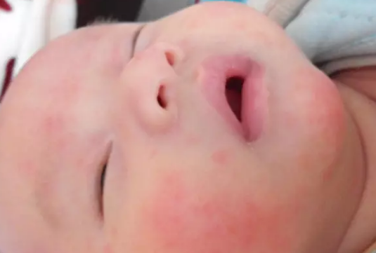 寶寶牛奶蛋白過敏的癥狀 寶寶牛奶過敏喝什么奶粉 寶寶牛奶蛋白過敏的癥狀 寶寶牛奶過敏喝什么奶粉