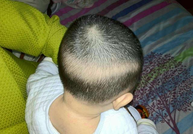 寶寶枕禿是缺鈣嗎 寶寶枕禿怎么改善