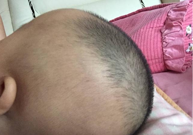 寶寶枕禿是缺鈣嗎 寶寶枕禿怎么改善
