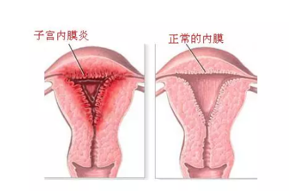 子宮內膜炎怎么檢查出來 慢性子宮內膜炎要做哪些檢查
