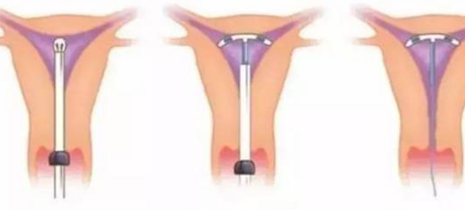 慢性子宮內膜炎發病原因 慢性子宮內膜炎癥狀有哪些