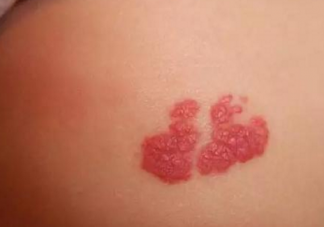 寶寶胎記和媽媽有關(guān)系嗎 寶寶胎記是怎么造成的