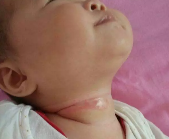 孩子脖子總是紅紅的是什么原因 脖子紅紅的的怎么辦