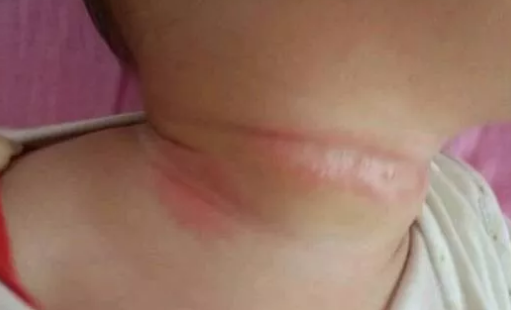 孩子脖子總是紅紅的是什么原因 脖子紅紅的的怎么辦