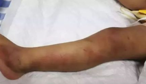 1歲女童被摔死怎么回事 1歲女童被母親男友摔死原因