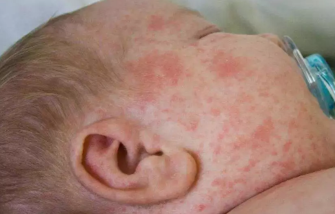 寶寶痱子怎么治見效最快 寶寶痱子怎么去除 寶寶痱子怎么治見效最快 寶寶痱子怎么去除