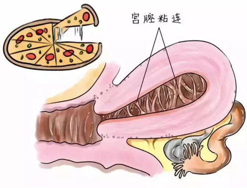 宮腔粘連會導(dǎo)致不孕嗎 宮腔粘連主要臨床表現(xiàn)