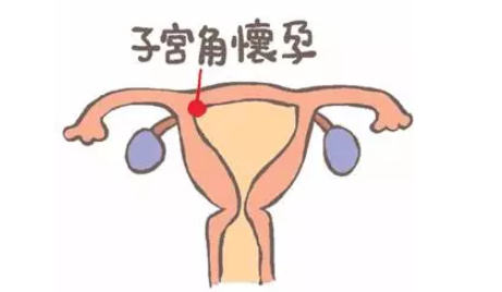 宮角妊娠回正位的辦法 宮角妊娠能成功生育嗎
