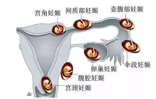 宮角妊娠最佳治療方法 宮角妊娠的治療方法有哪些