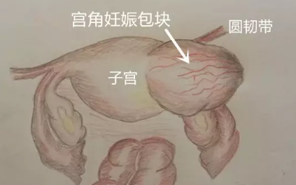 宮角妊娠的原因有哪些 宮角妊娠是如何引起的 宮角妊娠的原因有哪些 宮角妊娠是如何引起的