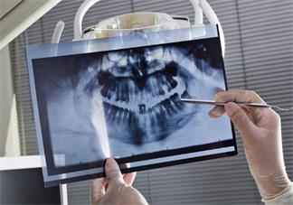 x光片是什么垃圾 x光片是干垃圾嗎