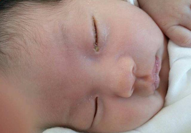 寶寶眼屎又多又黃是上火了嗎 清理眼屎的四大步驟 寶寶眼屎又多又黃是上火了嗎 清理眼屎的四大步驟