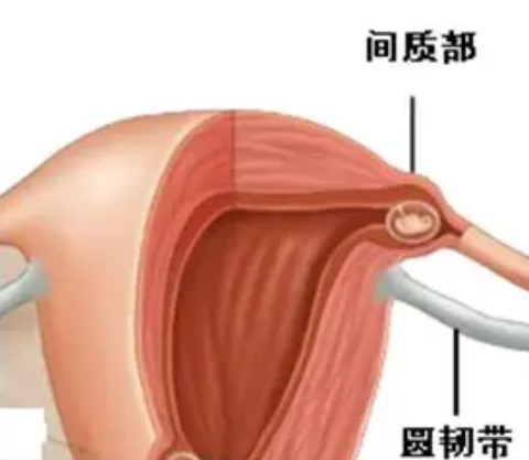 輸卵管間質部妊娠特點 輸卵管間質部妊娠是什么