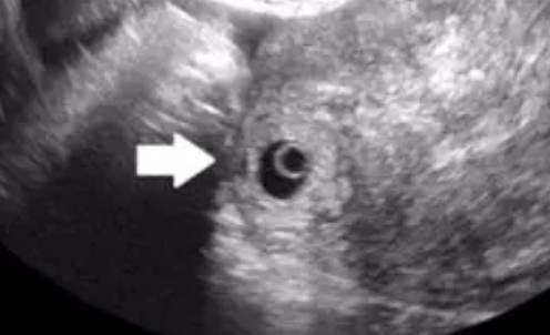 輸卵管間質部妊娠特點 輸卵管間質部妊娠是什么