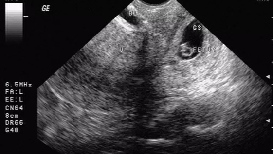 宮頸妊娠診斷標(biāo)準(zhǔn) 宮頸妊娠有哪些癥狀影響