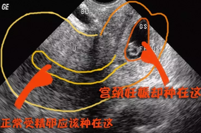 宮頸妊娠的治療方法 宮頸妊娠手術過程