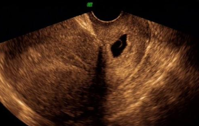 宮頸妊娠藥物怎么治療 宮頸妊娠是大手術(shù)嗎