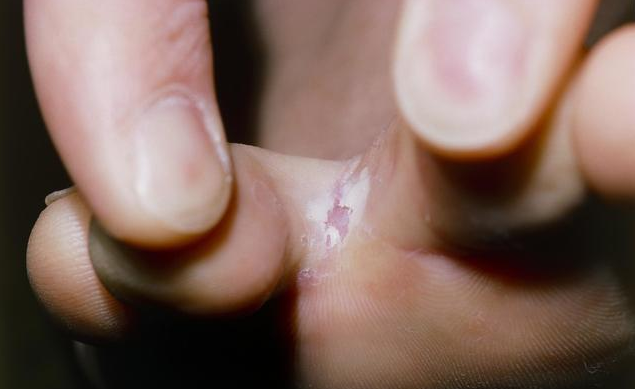 用醋泡腳可以治腳氣嗎 腳氣的不同類型及治療方法