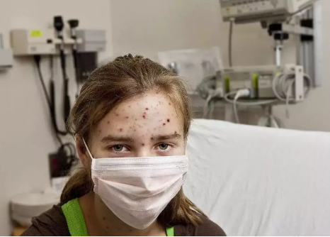 小孩得水痘的初期癥狀是什么 小孩得水痘注意事項