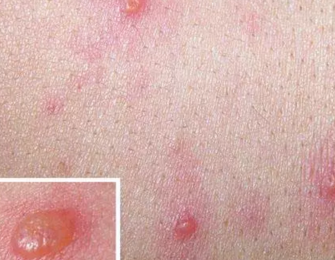 小孩得水痘的初期癥狀是什么 小孩得水痘注意事項