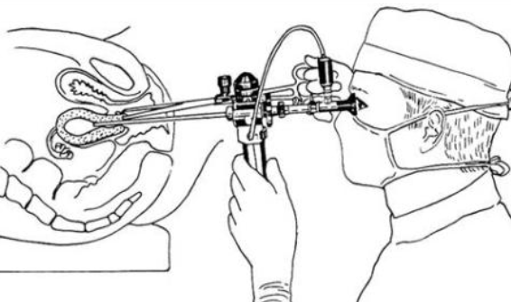 宮腔鏡檢查后注意什么 宮腔鏡檢查后有并發(fā)癥嗎