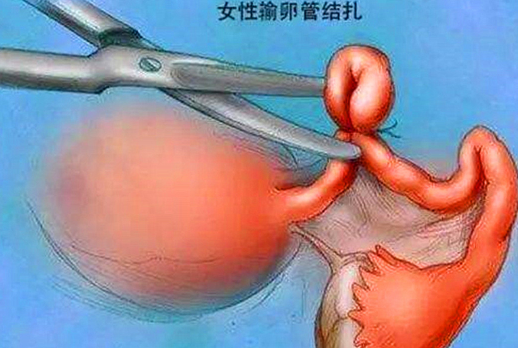 生完好孩子結扎還是上環好 結扎和上環有什么不同 生完好孩子結扎還是上環好 結扎和上環有什么不同