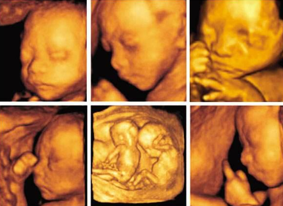 四維彩超寶寶為什么愛捂臉 四維彩超檢查應該看哪些指標