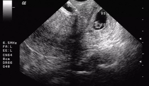 宮頸妊娠要做哪些檢查 宮頸妊娠的臨床表現(xiàn)癥狀