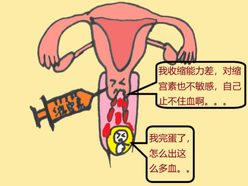 宮頸妊娠要做清宮手術嗎 宮頸妊娠要做什么治療最好