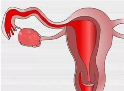 雙角子宮對懷孕有哪些影響 怎么判斷是不是雙角子宮 雙角子宮對懷孕有哪些影響 怎么判斷是不是雙角子宮