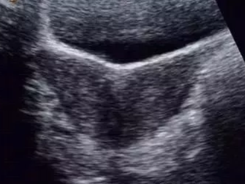 為什么會出現雙角子宮 雙角子宮對女性懷孕的影響有哪些 為什么會出現雙角子宮 雙角子宮對女性懷孕的影響有哪些