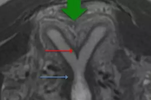 為什么會出現雙角子宮 雙角子宮對女性懷孕的影響有哪些 為什么會出現雙角子宮 雙角子宮對女性懷孕的影響有哪些