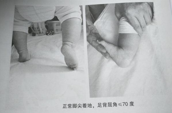 寶寶腳尖走路是腦癱嗎 如何區分足尖走路是正常還是異常