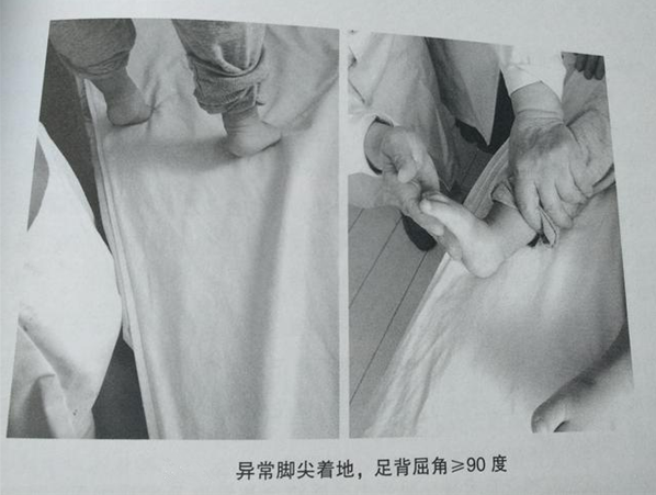 寶寶腳尖走路是腦癱嗎 如何區分足尖走路是正常還是異常