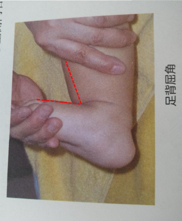 寶寶腳尖走路是腦癱嗎 如何區分足尖走路是正常還是異常