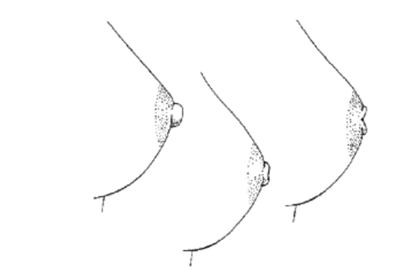 寶寶有乳頭錯覺是怎么回事 寶寶乳頭錯覺還能糾正過來嗎