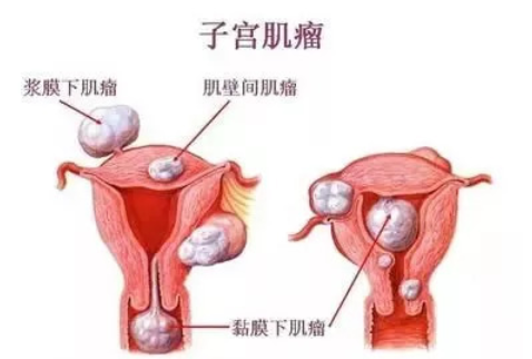 子宮偏小還能懷孕嗎 子宮偏小懷孕的幾率就小嗎 子宮偏小還能懷孕嗎 子宮偏小懷孕的幾率就小嗎
