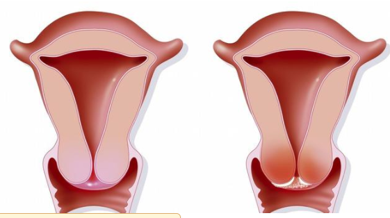 宮頸癌的高危人群有哪些 宮頸癌的治療方法 宮頸癌的高危人群有哪些 宮頸癌的治療方法