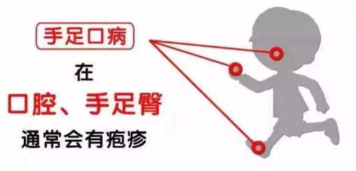寶寶皰疹性咽峽炎和手足口病區別 如何預防小兒皰疹性咽峽炎