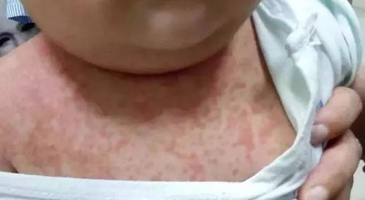 寶寶猩紅熱可以洗澡嗎 寶寶猩紅熱出疹特點 寶寶猩紅熱可以洗澡嗎 寶寶猩紅熱出疹特點
