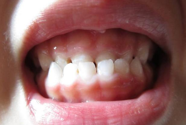 孩子牙齒地包天是怎么形成的 孩子地包天最佳治療時間